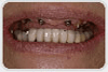 dental_implants_after