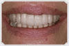 dental_implants_before